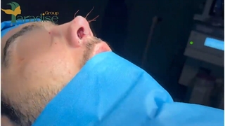 جراحی بینی مردانه با قوز زیاد