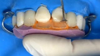 کامپوزیت دندان - مواد دندانپزشکی