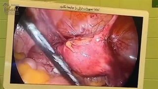 فیلم درمان چسبندگی رحم در خانم مسن