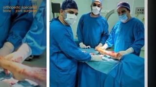 فیلم جراحی شکستگی ساق پا