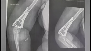 فیلم جراحی آرنج و رضایت بیمار