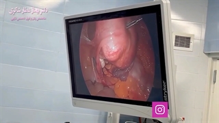 فیلم واقعی لاپاراسکوپی رحم