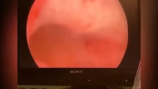 هیستروسکوپی رحم