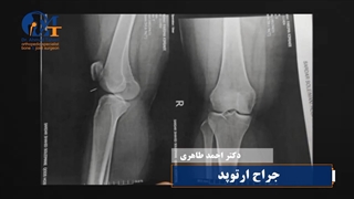 فیلم جراحی تعویض مفصل زانو