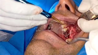 جراحی سینوس لیفت همزمان با دو ایمپلنت