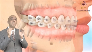 برای عمل فک حتما نیاز به ارتودنسی است؟