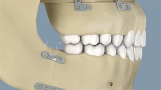 جراحی دو فک