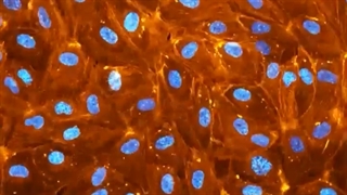 تهاجم سلول های سرطان پستان