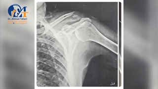فیلم جراحی ترمیم شکستگی استخوان شانه