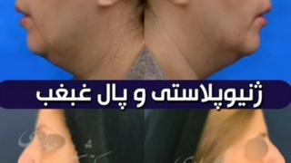 ژنیوپلاستی و ساکشن غبغب