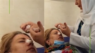 تزریق بوتاکس در ناحیه پیشانی
