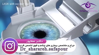 چگونگی انجام لیزیک