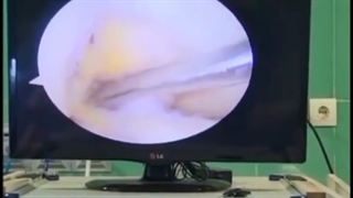 فیلم واقعی جراحی بازسازی رباط صلیبی