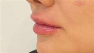 فیلم تزریق ژل لب با تغییر بسیار زیاد