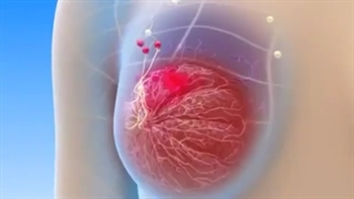 اصلا میدونی سرطان سینه چیه؟