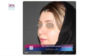 جراحی رینوپلاستی طبیعی
