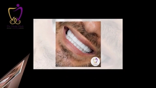 اصلاح طرح لبخند