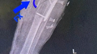 فیلم درمان ساق پا متلاشی شده