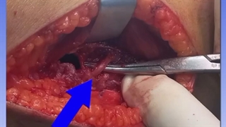 فیلم واقعی خارج سازی تومور استخوانی