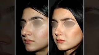 نمونه ای جراحی رینوپلاستی طبیعی