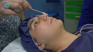 فرم بینی مردانه