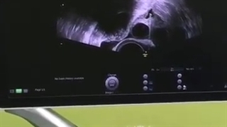 عمل پانکچر تخمدان تحت بیهوشی