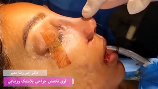 رینوپلاستی