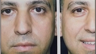بلافاصله پس از عمل بینی استخوانی همراه با کجی