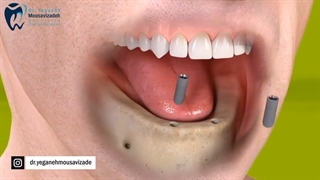 ایملنت تمام فک