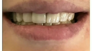 کامپوزیت کنم یا لمینت ؟؟؟