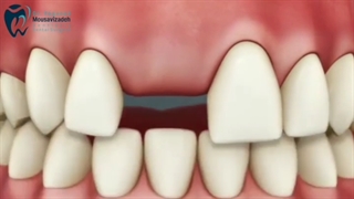 بریچ یا ایمپلنت ؟؟؟