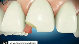 اصلاح طرح لبخند