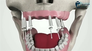 ایمپلنت تمام فک بالا