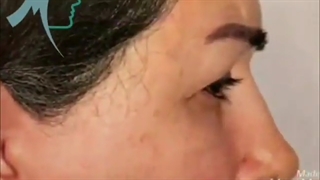 لیفت ابرو و پیشانی برای خانم ۵۷ ساله .