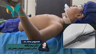 فیلم جراحی شکستگی آرنج کودک 7 ساله