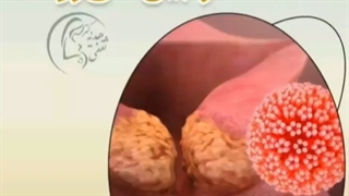 آیا زگیل‌ها به خودی خود از بین می‌روند؟