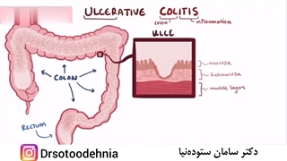 بیماری التهابی روده بزرگ ( کولیت )