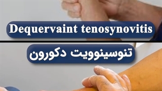 تزریق در تنوسینوویت دکورون ⭕ که باعث التهاب در تاندون های حرکت دهنده شست میشود ❎