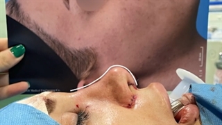 جراحی رینوپلاستی طبیعی برای مراجعه کننده خانم