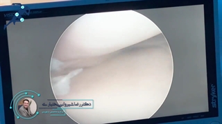 ترمیم منیسک ... مهمترین نکته در آرتروسکوپى زانو‼️