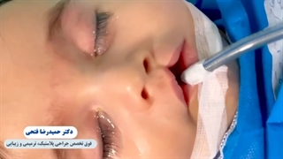 جراحی شکاف کام لب برای نوزاد