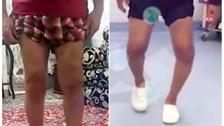 ⭕تغییر واضح راه رفتن و محور اندام ها بعد از جراحى تعویض مفصل هر دو زانو⭕