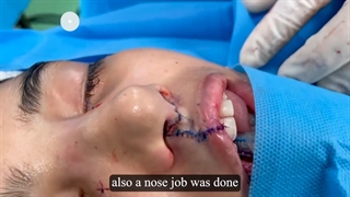 ✨جراحی همزمان شکاف کام لب و رینوپلاستی برای مراجعه کننده عزیزمون✨