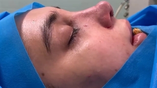 جراحی رینوپلاستی کاملا طبیعی