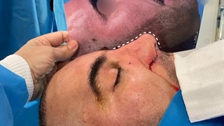 جراحی رینوپلاستی کاملا مردانه و طبیعی