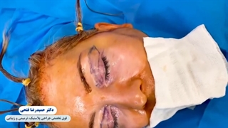 لیفت آندوسکوپی پیشانی و بلفاروپلاستی