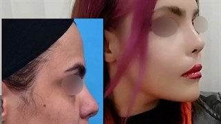 رضایتمندی مراجعه کننده عزیز از جراحی بینی