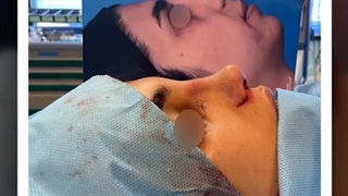 بلافاصله بعد از جراحی رینوپلاستی کاملا طبیعی