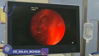 جراحی تومور