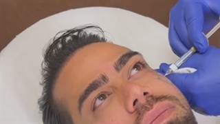 فرمدهی و کانتورینگ صورت با فیلر پرفکتا